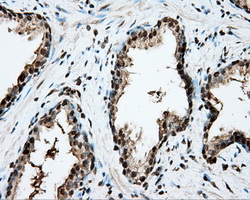 CYP1A2 Antibody - IHC of paraffin-embedded Carcinoma of prostate tissue using anti-CYP1A2 mouse monoclonal antibody. (Dilution 1:50).