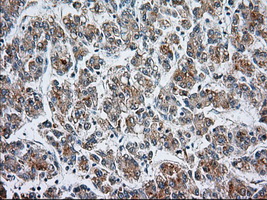 CYP1A2 Antibody - Immunohistochemical staining of paraffin-embedded Carcinoma of liver tissue using anti-CYP1A2 mouse monoclonal antibody. (Dilution 1:50).