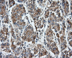 CYP1A2 Antibody - Immunohistochemical staining of paraffin-embedded Carcinoma of liver tissue using anti-CYP1A2 mouse monoclonal antibody. (Dilution 1:50).