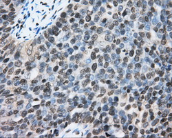 CYP1A2 Antibody - Immunohistochemical staining of paraffin-embedded Adenocarcinoma of ovary tissue N93ing anti-CYP1A2 mouse monoclonal antibody. (Dilution 1:50).