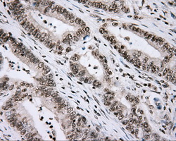 CYP1A2 Antibody - IHC of paraffin-embedded Adenocarcinoma of colon tissue using anti-CYP1A2 mouse monoclonal antibody. (Dilution 1:50).