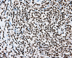 CYP1A2 Antibody - IHC of paraffin-embedded Carcinoma of thyroid tissue using anti-CYP1A2 mouse monoclonal antibody. (Dilution 1:50).