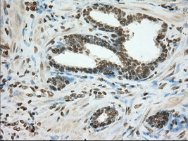 CYP1A2 Antibody - IHC of paraffin-embedded Carcinoma of Human prostate tissue using anti-CYP1A2 mouse monoclonal antibody. (Dilution 1:50).