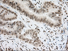 CYP1A2 Antibody - IHC of paraffin-embedded Adenocarcinoma of Human colon tissue using anti-CYP1A2 mouse monoclonal antibody. (Dilution 1:50).