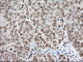 CYP1A2 Antibody - IHC of paraffin-embedded Adenocarcinoma of Human ovary tissue using anti-CYP1A2 mouse monoclonal antibody. (Dilution 1:50).