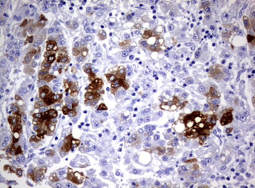 CYP1A2 Antibody - Immunohistochemical staining of paraffin-embedded Carcinoma of Human liver tissue using anti-CYP1A2 mouse monoclonal antibody.  heat-induced epitope retrieval by 10mM citric buffer, pH6.0, 120C for 3min)