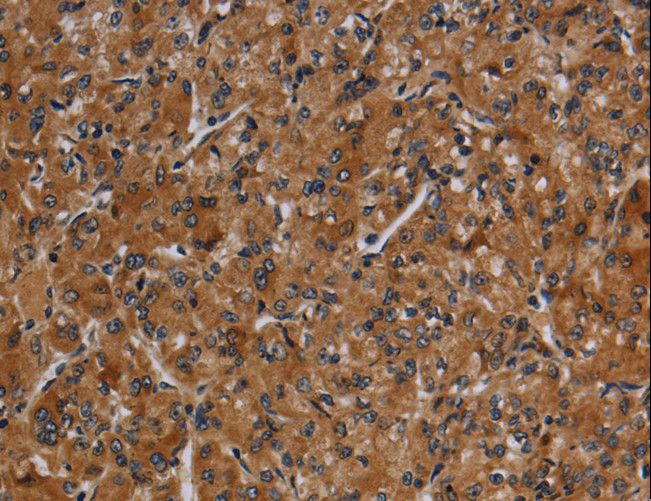 CYP1A2 Antibody - Immunohistochemistry of paraffin-embedded Human prostate cancer using CYP1A2 Polyclonal Antibody at dilution of 1:40.