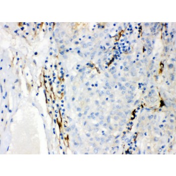 CYP1B1 Antibody - CYP1B1 antibody IHC-paraffin. IHC(P): Human Liver Cancer Tissue.