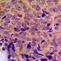 CYP21A2 Antibody - Immunohistochemical analysis of Cytochrome P450 21A2 staining in human breast cancer formalin fixed paraffin embedded tissue section. The section was pre-treated using heat mediated antigen retrieval with sodium citrate buffer (pH 6.0). The section was then incubated with the antibody at room temperature and detected with HRP and DAB as chromogen. The section was then counterstained with hematoxylin and mounted with DPX.