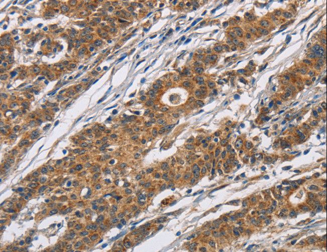 CYP21A2 Antibody - Immunohistochemistry of paraffin-embedded Human thyroid cancer using CYP21A2 Polyclonal Antibody at dilution of 1:60.