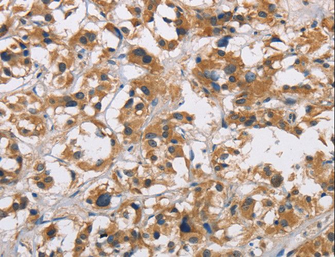 CYP21A2 Antibody - Immunohistochemistry of paraffin-embedded Human thyroid cancer using CYP21A2 Polyclonal Antibody at dilution of 1:60.