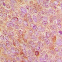 CYP24 / CYP24A1 Antibody - Immunohistochemical analysis of Cytochrome P450 24A1 staining in human breast cancer formalin fixed paraffin embedded tissue section. The section was pre-treated using heat mediated antigen retrieval with sodium citrate buffer (pH 6.0). The section was then incubated with the antibody at room temperature and detected with HRP and DAB as chromogen. The section was then counterstained with hematoxylin and mounted with DPX.