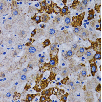 CYP24 / CYP24A1 Antibody - Immunohistochemistry of paraffin-embedded human liver cancer using CYP24A1 antibodyat dilution of 1:200 (40x lens).