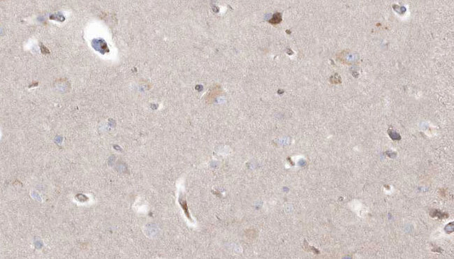 CYP26B1 Antibody - 1:100 staining human brain carcinoma tissue by IHC-P. The sample was formaldehyde fixed and a heat mediated antigen retrieval step in citrate buffer was performed. The sample was then blocked and incubated with the antibody for 1.5 hours at 22°C. An HRP conjugated goat anti-rabbit antibody was used as the secondary.