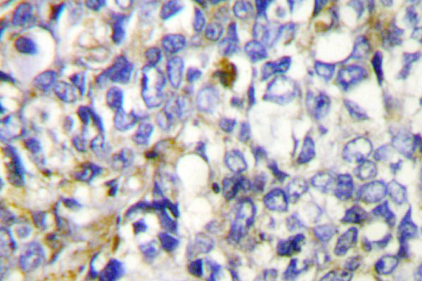 CYP27 / CYP27A1 Antibody - IHC of CYP27A1 (E131) pAb in paraffin-embedded human lung carcinoma tissue.