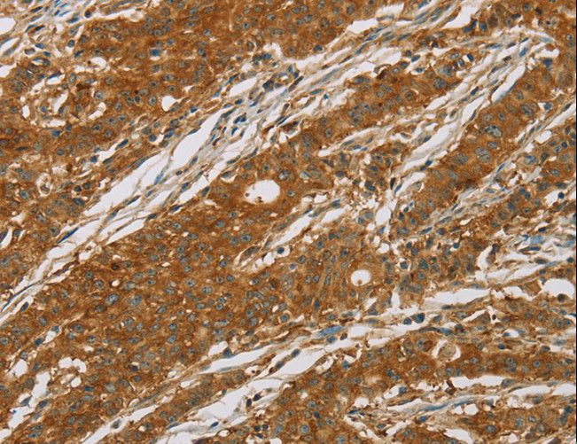 CYP27 / CYP27A1 Antibody - Immunohistochemistry of paraffin-embedded Human liver cancer using CYP27A1 Polyclonal Antibody at dilution of 1:50.