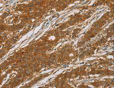 CYP27 / CYP27A1 Antibody - Immunohistochemistry of paraffin-embedded Human liver cancer using CYP27A1 Polyclonal Antibody at dilution of 1:50.