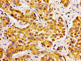 CYP27 / CYP27A1 Antibody - Immunohistochemistry image of paraffin-embedded human liver cancer at a dilution of 1:100