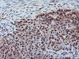 CYP2A6 Antibody - IHC of paraffin-embedded Adenocarcinoma of Human ovary tissue using anti-CYP2A6 mouse monoclonal antibody.