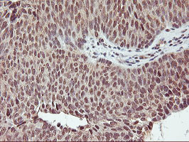 CYP2A6 Antibody - IHC of paraffin-embedded Carcinoma of Human bladder tissue using anti-CYP2A6 mouse monoclonal antibody.