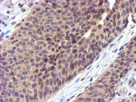 CYP2A6 Antibody - IHC of paraffin-embedded Carcinoma of Human bladder tissue using anti-CYP2A6 mouse monoclonal antibody. (Heat-induced epitope retrieval by 10mM citric buffer, pH6.0, 100C for 10min).