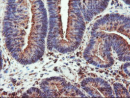 CYP2B6 Antibody - IHC of paraffin-embedded Adenocarcinoma of Human colon tissue using anti-CYP2B6 mouse monoclonal antibody. (Heat-induced epitope retrieval by 10mM citric buffer, pH6.0, 100C for 10min).