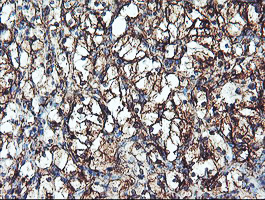 CYP2B6 Antibody - IHC of paraffin-embedded Carcinoma of Human kidney tissue using anti-CYP2B6 mouse monoclonal antibody. (Heat-induced epitope retrieval by 10mM citric buffer, pH6.0, 100C for 10min).