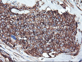 CYP2B6 Antibody - IHC of paraffin-embedded Adenocarcinoma of Human breast tissue using anti-CYP2B6 mouse monoclonal antibody. (Heat-induced epitope retrieval by 10mM citric buffer, pH6.0, 100C for 10min).