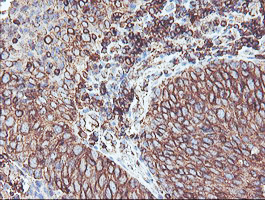 CYP2B6 Antibody - IHC of paraffin-embedded Carcinoma of Human bladder tissue using anti-CYP2B6 mouse monoclonal antibody. (Heat-induced epitope retrieval by 10mM citric buffer, pH6.0, 100C for 10min).