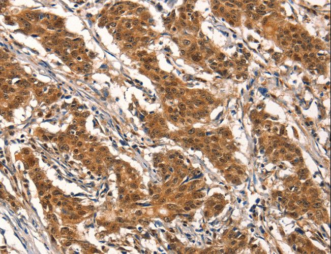 CYP2B6 Antibody - Immunohistochemistry of paraffin-embedded Human gastric cancer using CYP2B6 Polyclonal Antibody at dilution of 1:25.
