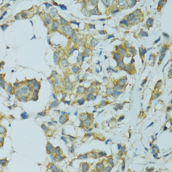 CYP2B6 Antibody - Immunohistochemistry of paraffin-embedded human breast cancer using CYP2B6 antibodyat dilution of 1:100 (40x lens).