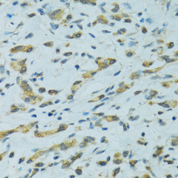CYP2B6 Antibody - Immunohistochemistry of paraffin-embedded human gastric cancer using CYP2B6 antibodyat dilution of 1:100 (40x lens).