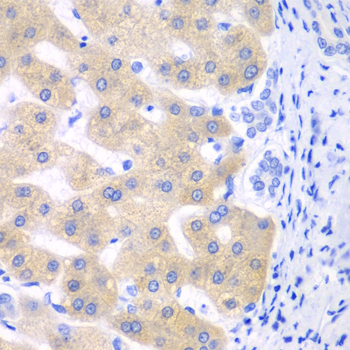 CYP2C18 / CYP2C Antibody - Immunohistochemistry of paraffin-embedded human liver cancer tissue.