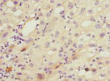 CYP2C18 / CYP2C Antibody - Immunohistochemistry of paraffin-embedded human liver cancer at dilution 1:100