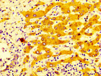 CYP2C19 Antibody - Immunohistochemistry image at a dilution of 1:400 and staining in paraffin-embedded human liver cancer performed on a Leica BondTM system. After dewaxing and hydration, antigen retrieval was mediated by high pressure in a citrate buffer (pH 6.0) . Section was blocked with 10% normal goat serum 30min at RT. Then primary antibody (1% BSA) was incubated at 4 °C overnight. The primary is detected by a biotinylated secondary antibody and visualized using an HRP conjugated SP system.