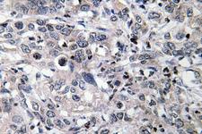 CYP2C19 Antibody - IHC of CYP2C19 (K270) pAb in paraffin-embedded human liver carcinoma tissue.