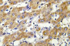 CYP2C8+9+18+19 Antibody - IHC of CYP2C8/9/18/19 (M136) pAb in paraffin-embedded human liver carcinoma tissue.