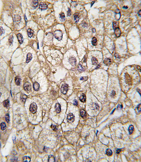 CYP2C9 / Cytochrome P450 2C9 Antibody - Formalin-fixed and paraffin-embedded human hepatocarcinoma tissue reacted with CYP2C9 antibody , which was peroxidase-conjugated to the secondary antibody, followed by DAB staining. This data demonstrates the use of this antibody for immunohistochemistry; clinical relevance has not been evaluated.