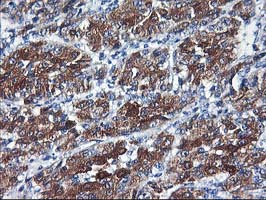 CYP2C9 / Cytochrome P450 2C9 Antibody - IHC of paraffin-embedded Carcinoma of Human liver tissue using anti-CYP2C9 mouse monoclonal antibody.