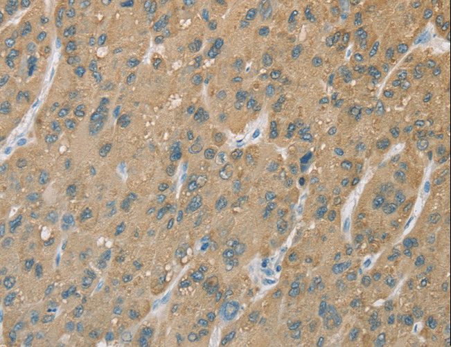CYP2C9 / Cytochrome P450 2C9 Antibody - Immunohistochemistry of paraffin-embedded Human gastric cancer using CYP2C9 Polyclonal Antibody at dilution of 1:50.