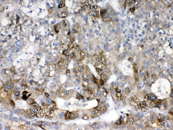 CYP2D6 Antibody - IHC testing of FFPE human liver cancer tissue with CYP2D6 antibody at 1ug/ml. Required HIER: steam section in pH6 citrate buffer for 20 min and allow to cool prior to testing.