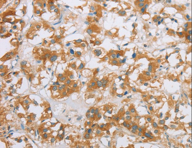 CYP2E1 Antibody - Immunohistochemistry of paraffin-embedded Human thyroid cancer using CYP2E1 Polyclonal Antibody at dilution of 1:35.