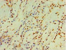 CYP2J2 Antibody - Immunohistochemistry of paraffin-embedded human breast cancer using antibody at 1:100 dilution.