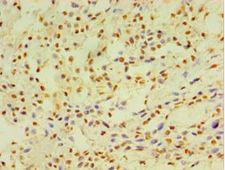 CYP2J2 Antibody - Immunohistochemistry of paraffin-embedded human breast cancer using antibody at 1:100 dilution.