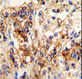CYP2J2 Antibody - Formalin-fixed and paraffin-embedded human hepatocarcinoma reacted with CYP2J2 Antibody , which was peroxidase-conjugated to the secondary antibody, followed by DAB staining. This data demonstrates the use of this antibody for immunohistochemistry; clinical relevance has not been evaluated.