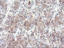 CYP2J2 Antibody - IHC of paraffin-embedded Carcinoma of Human liver tissue using anti-CYP2J2 mouse monoclonal antibody.