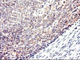 CYP2J2 Antibody - IHC of paraffin-embedded Adenocarcinoma of Human ovary tissue using anti-CYP2J2 mouse monoclonal antibody.