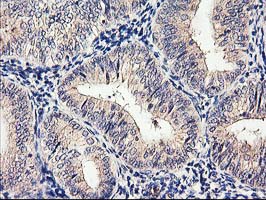 CYP2J2 Antibody - IHC of paraffin-embedded Adenocarcinoma of Human endometrium tissue using anti-CYP2J2 mouse monoclonal antibody.