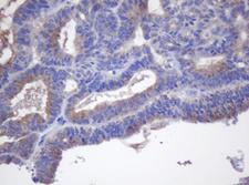 CYP2J2 Antibody - IHC of paraffin-embedded Adenocarcinoma of Human endometrium tissue using anti-CYP2J2 mouse monoclonal antibody.