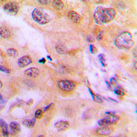 CYP2J2 Antibody - Immunohistochemical analysis of Cytochrome P450 2J2 staining in human liver cancer formalin fixed paraffin embedded tissue section. The section was pre-treated using heat mediated antigen retrieval with sodium citrate buffer (pH 6.0). The section was then incubated with the antibody at room temperature and detected using an HRP conjugated compact polymer system. DAB was used as the chromogen. The section was then counterstained with hematoxylin and mounted with DPX.
